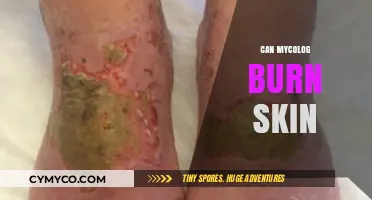 Can Mycolog Cause Skin Burns? Understanding Risks and Safety Tips