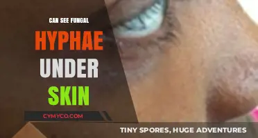 Visible Fungal Hyphae Under Skin: Causes, Symptoms, and Treatment Options