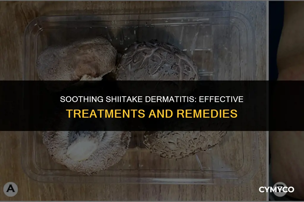 how is shiitake dermatitis treated