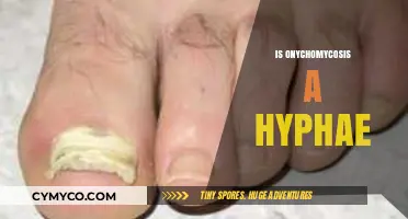 Unveiling the Truth: Is Onychomycosis Caused by Hyphae?
